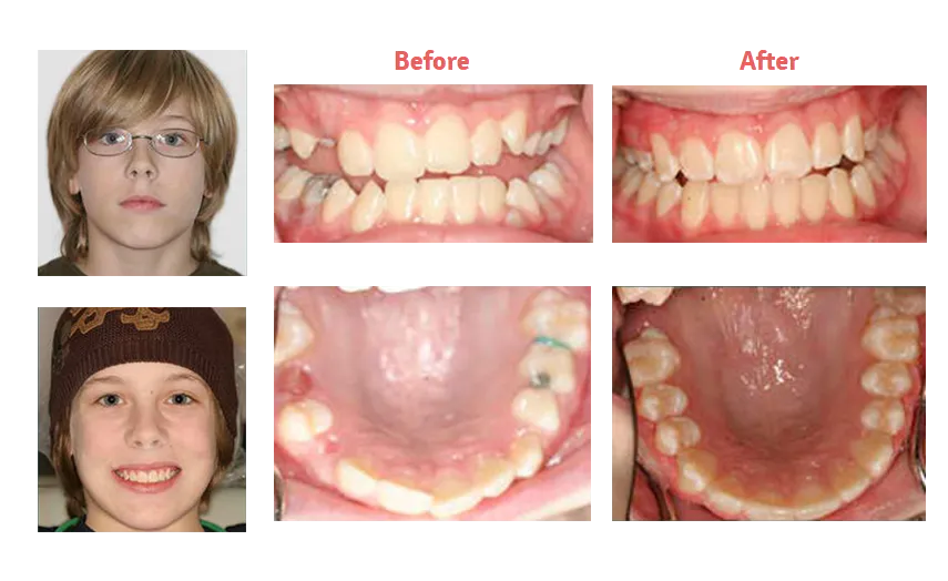 collages of images showing young boy with glasses, smaller images showing his teeth before and after orthodontic treatment, braces New Baltimore, MI dentist