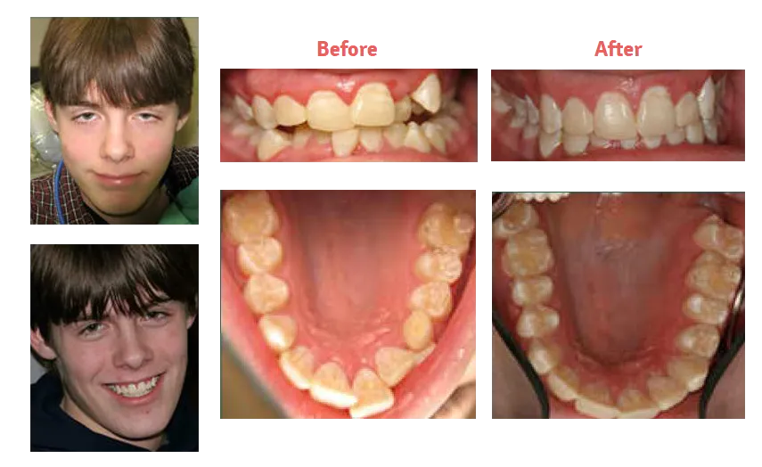 collage of images showing teen boy smiling and how his teeth looked before and after treatment, orthodontics New Baltimore, MI