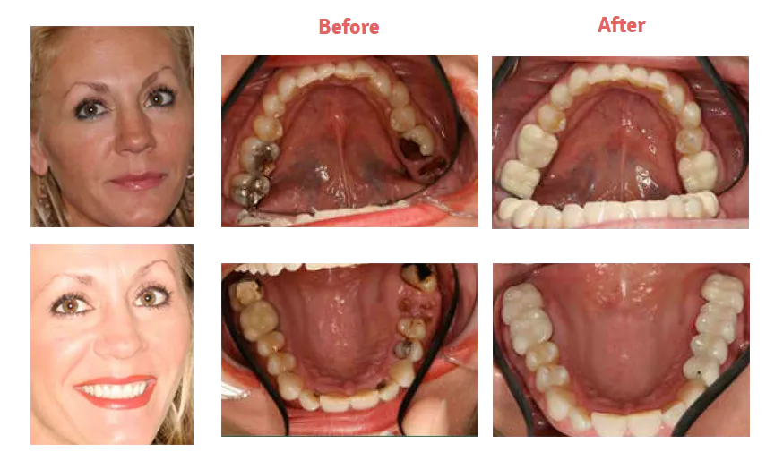 group of six images, two of woman smiling, four are close up of her mouth showing teeth before and after dental crowns New Baltimore, MI dental bridge