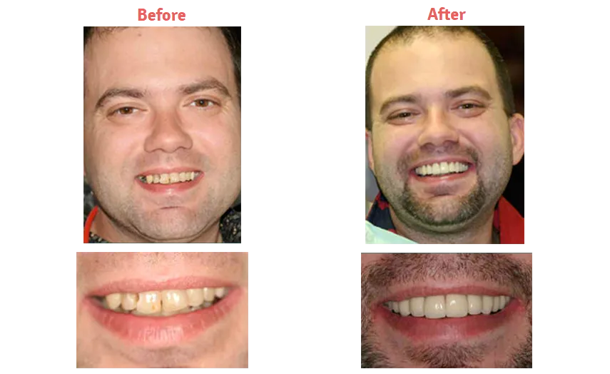 group of four images, two of man smiling and two of his mouth close up, before and after dental crowns and bridges New Baltimore, MI dentist