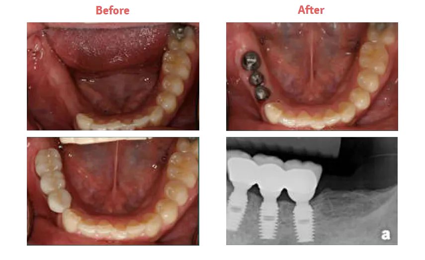 before and after image collage showing multiple missing teeth and stages of them being replaced by dental implants New Baltimore, MI dentist
