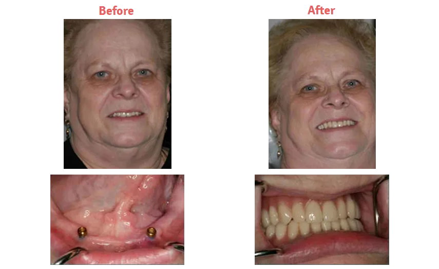 before and after images of elderly woman's teeth with dentures, then after she gets implant dentures New Baltimore, MI dentist