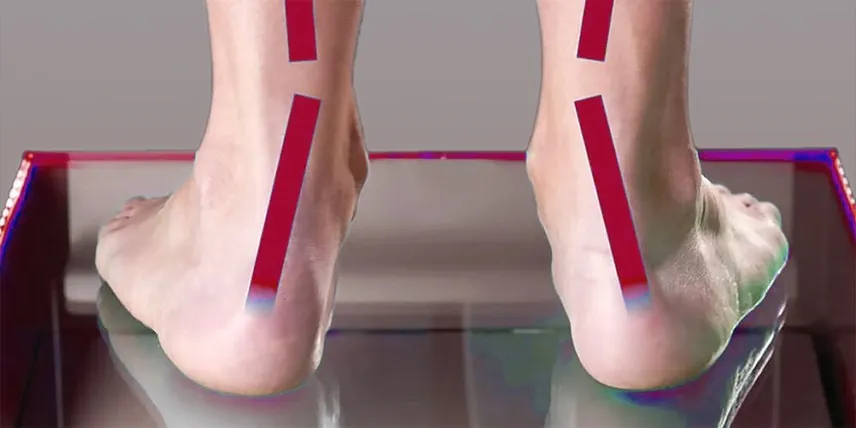 flat feet (pes planus)