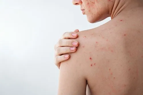 Woman showing acne on her cheeks and back
