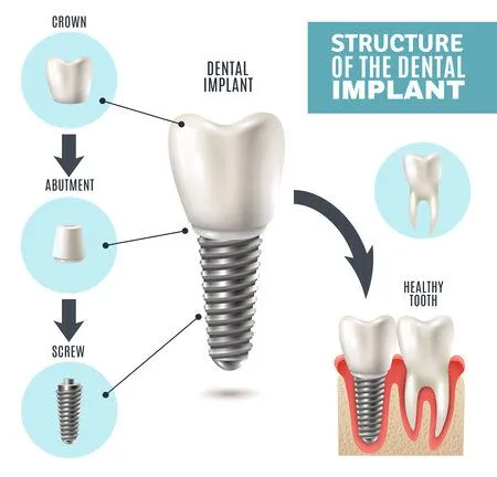 illustrated diagram "Structure of the Dental Implant" showing implant parts and assembly, dental implants Oxnard, CA dentist