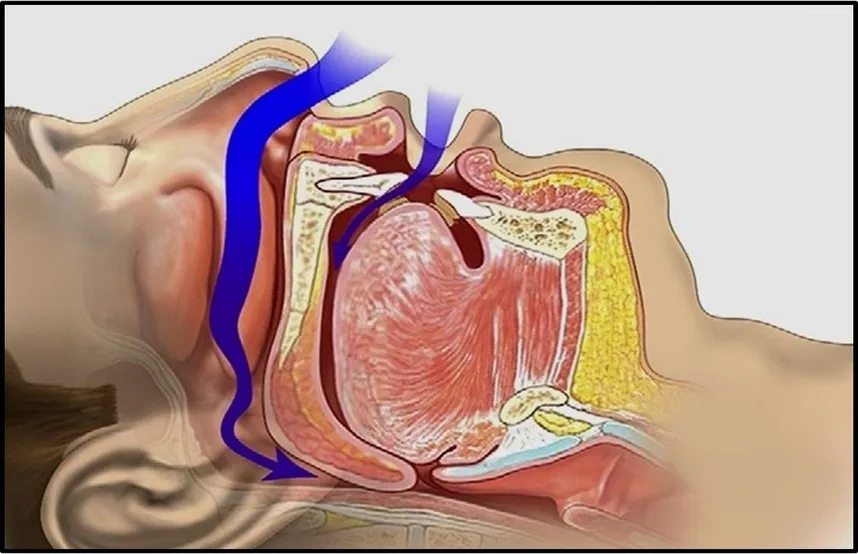 illustration of obstructed breathing in throat passages sleep apnea Syracuse, NY