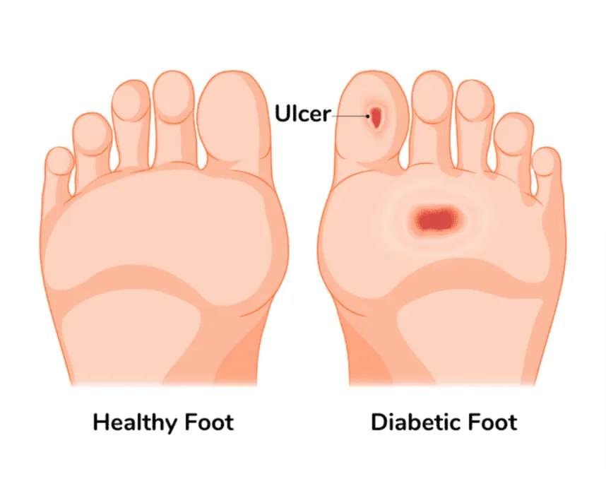 Diabetic Wound Care Santa Maria CA