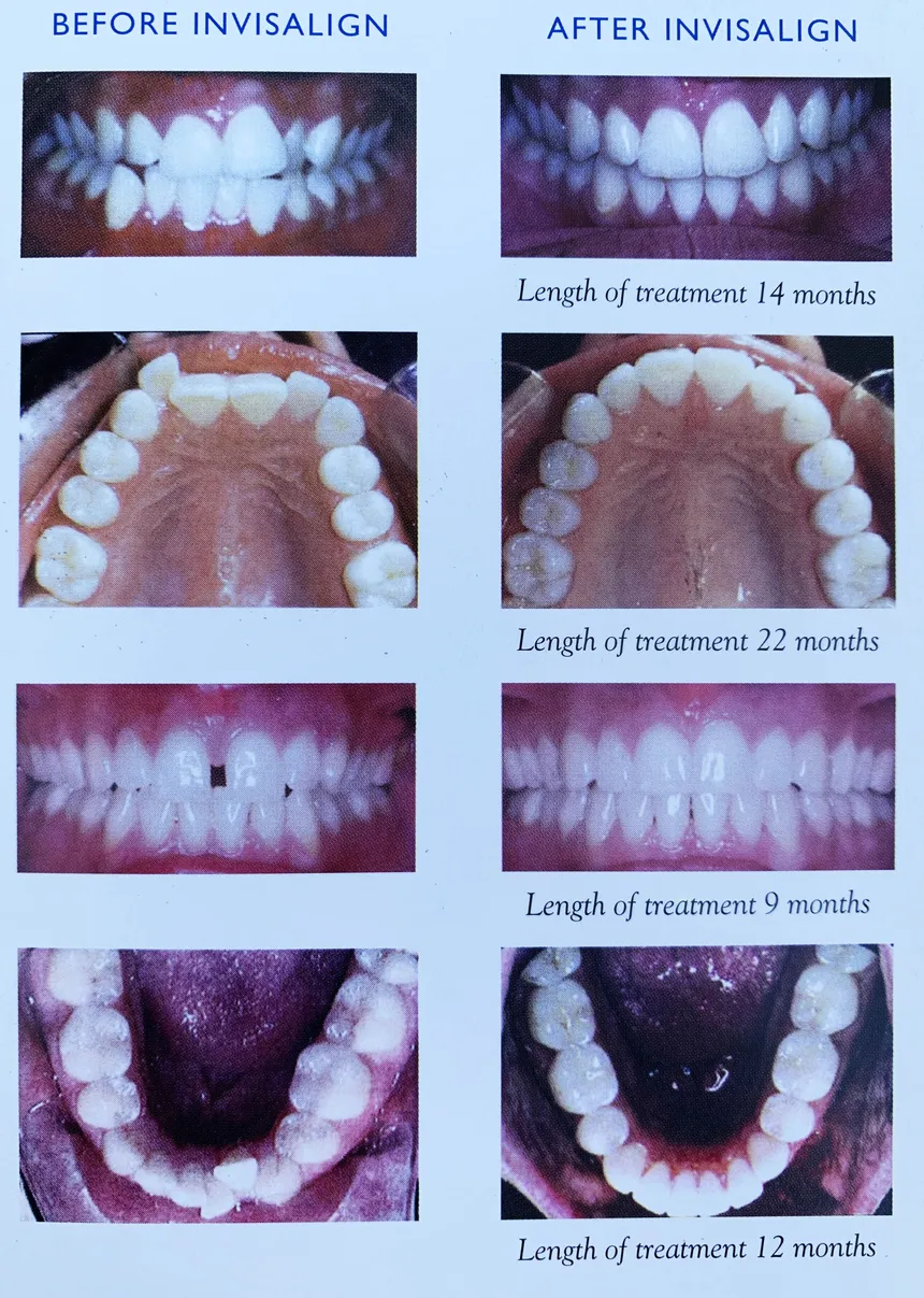 Invisalign in Reston, VA