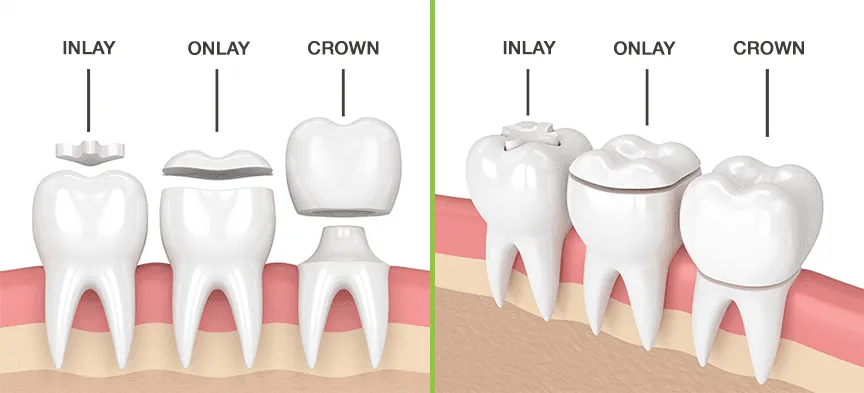 inlay