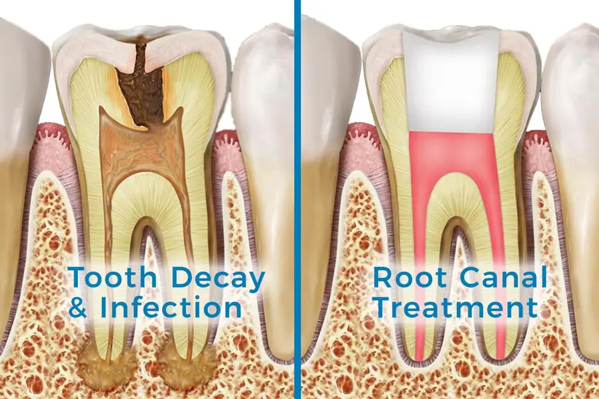 root canal