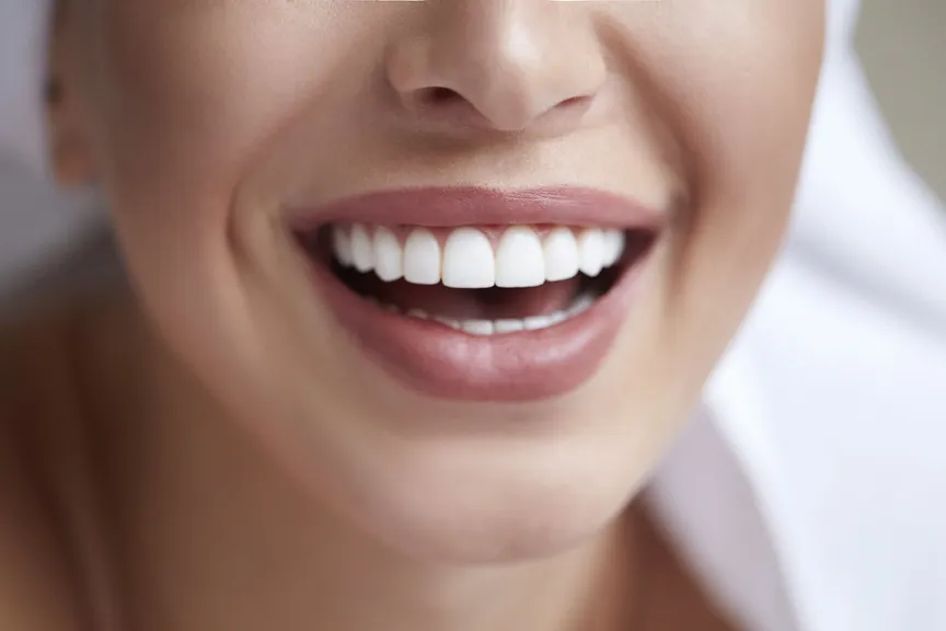 Porcelain Veneers - Wichita, KS Dentist | Wichita Dental Group, PA