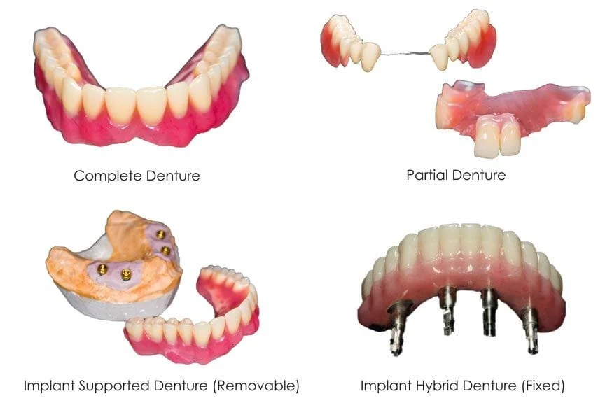 illustration showing types of dentures Westminster, MD family dentist