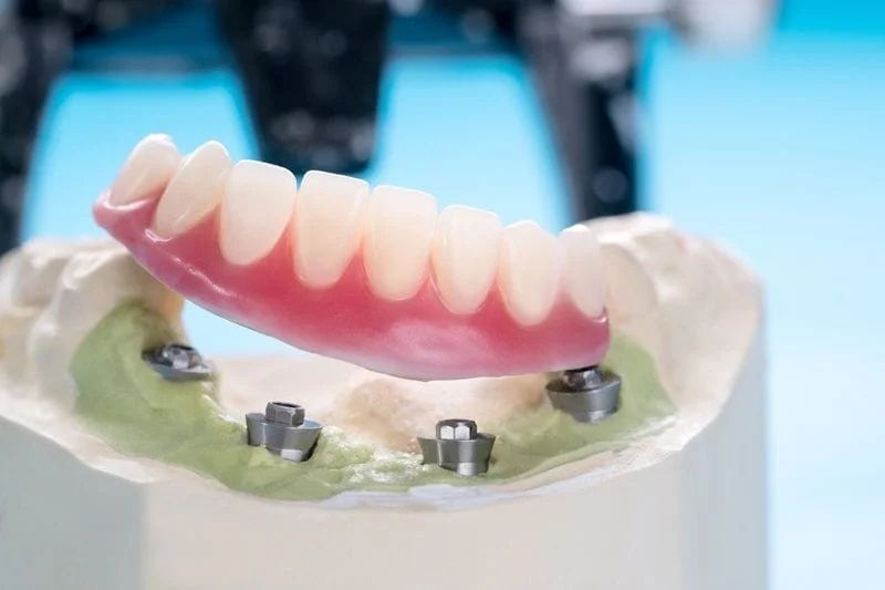 Implant Dentures - Kenosha, WI Dentist | Modern Family Dentists
