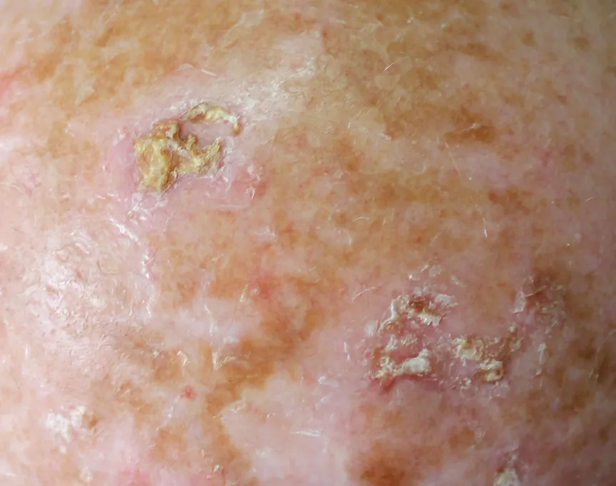 actinic-keratosis