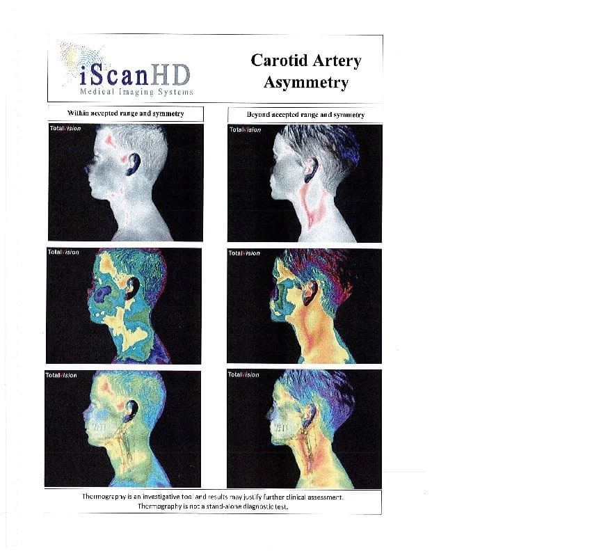 Thermography -- Carotid Artery Asymmetry