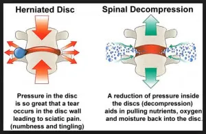 Decomp3