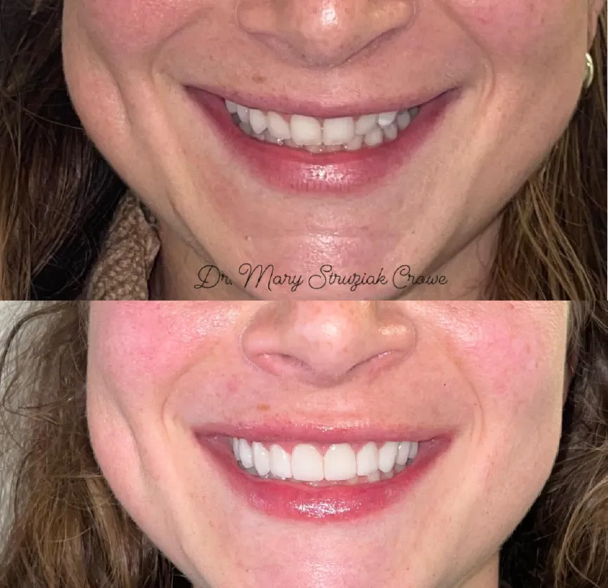 Photograph of woman after Cosmetic Dentistry, Chicago Loop, IL