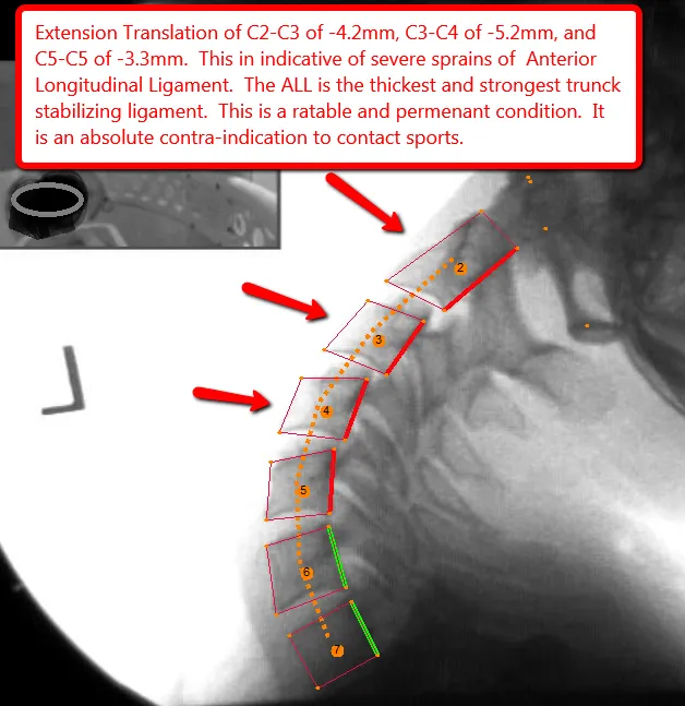 DMX_Left_Lateral_Distal_Humeral_Head