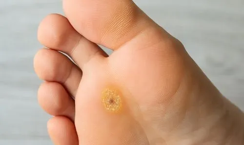Foot sole with visible verruca (plantar wart).
