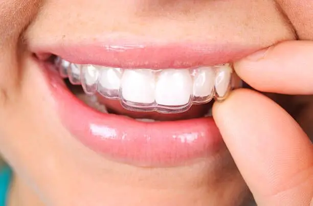 Photograph of smiling woman wearing Invisalign, Santa Clara, CA