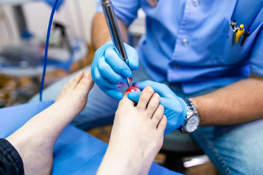 laser toenail fungus removal in Laguna Hills, CA
