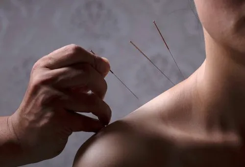Client undergoing acupuncture session for persistent shoulder discomfort.