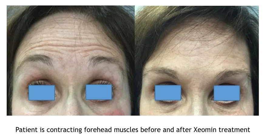 Neuromodulators Before and After