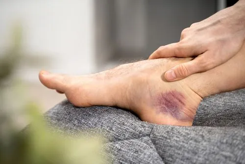 Close-up view of a man's foot with a sprained ankle and visible bruising