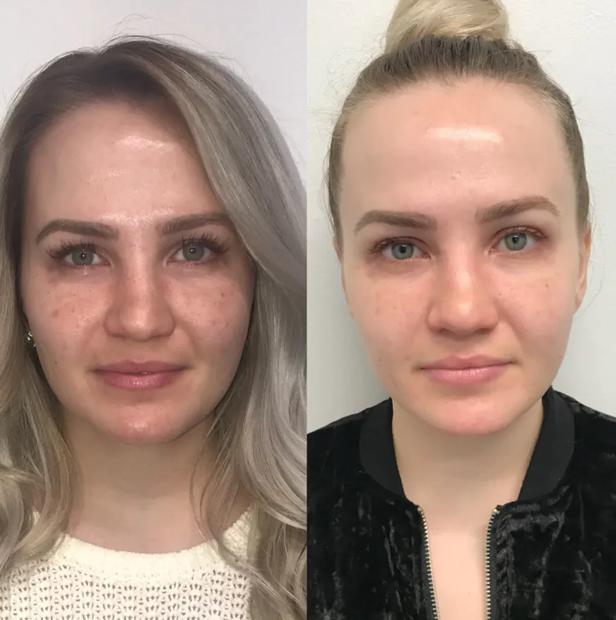 skin rejuvenation before and after 4