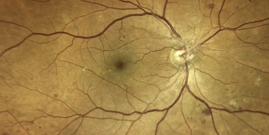 diabetic retinopathy