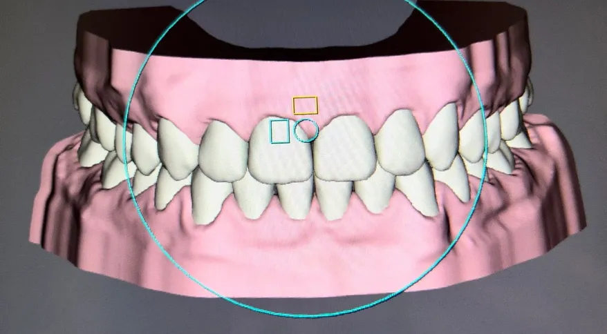 computer rendering of top and bottom teeth straight with no gaps, showing teeth after treatment with SureSmile clear aligners New Baltimore, MI