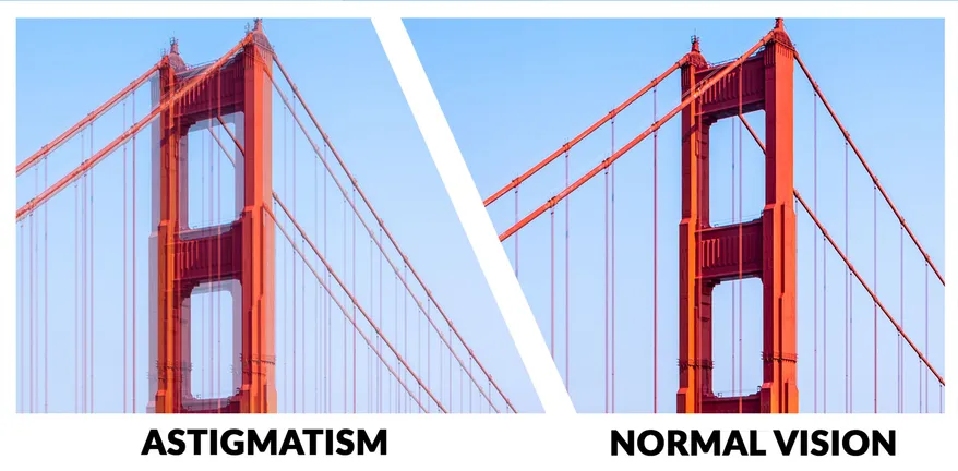 Astigmatism |  Dan Rod Eyes - Covered Eye Exam with VSP Eyemed in Los Angeles, Santa Monica, Culver City, Beverlywood, Cheviot Hills, Beverly Hills, Century City, West LA, Rancho Park, Westwood, Palms, CA,