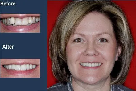 invisalign, crowns, veneers, bridge