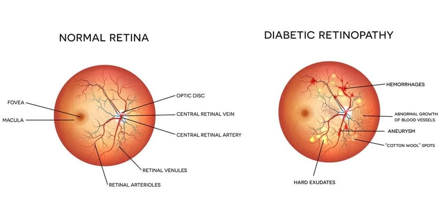 Illustration of Diabetic Retinopathy