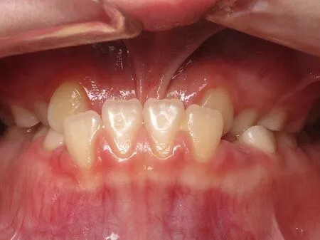 Severe underbite before 