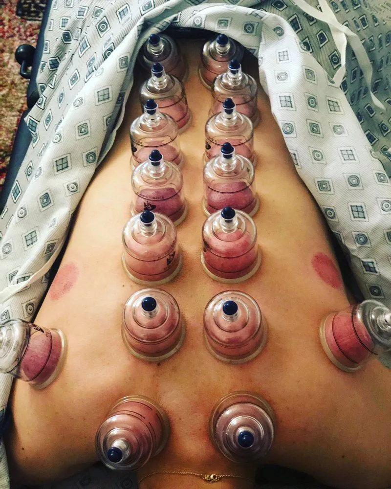 cupping