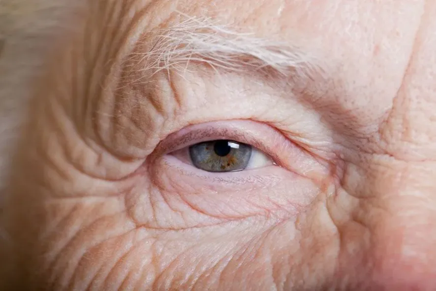 Close up of an elderly patient's eye