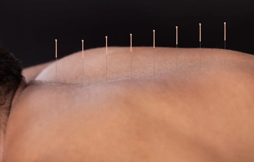 Acupuncture