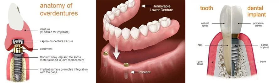 Removable Implant Denture