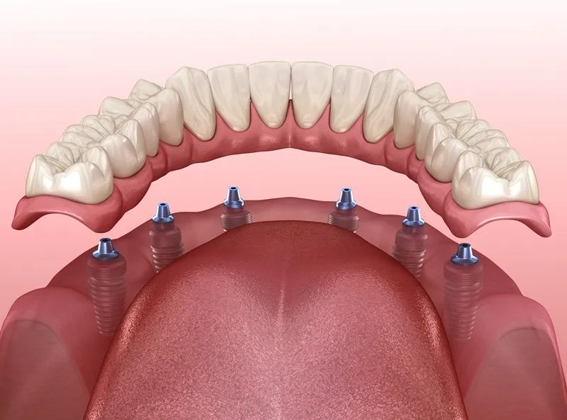 allon6implant