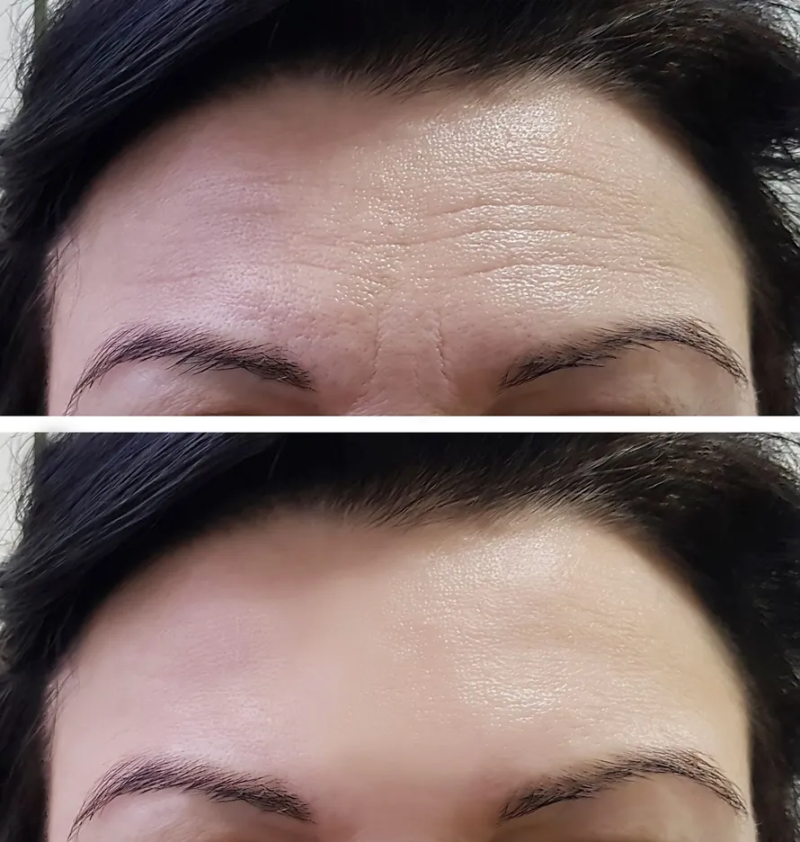 Botox before/after