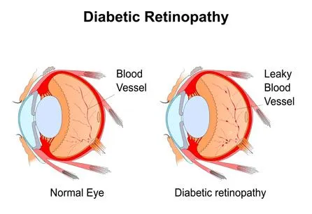 Diabetic Eye Diagram