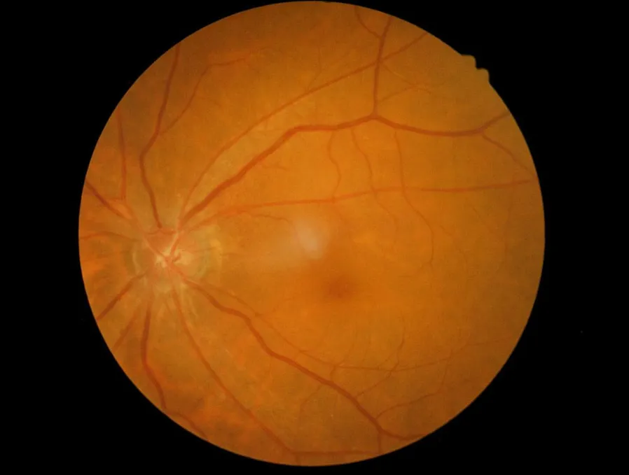 An image of Macular Degeneration