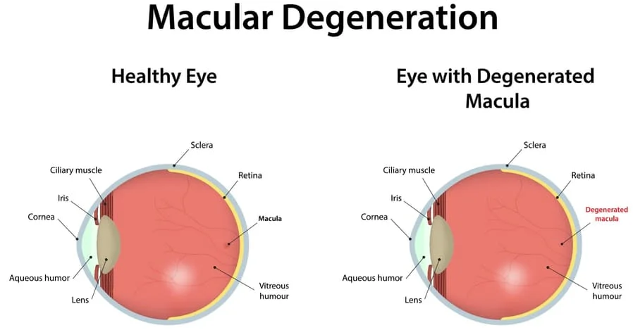 macular degeneration chart