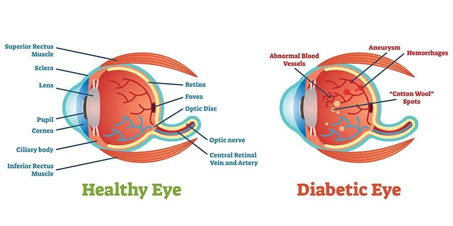 Healthy Eye vs Diabetic Retinopathy