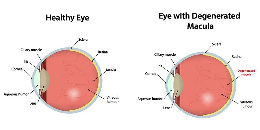 Healthy Eye vs Macular Degeneration