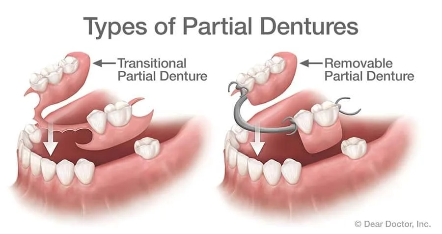Types of Partial Dentures.
