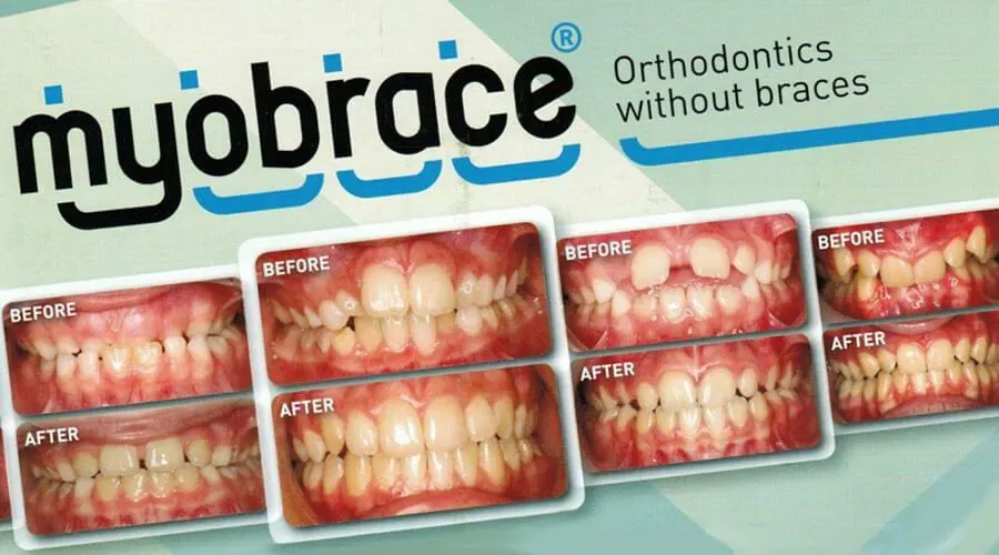 myobracebeforeafter