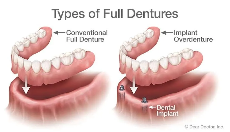 Types of Full Dentures.
