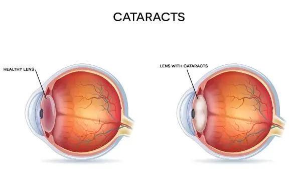 cataracts